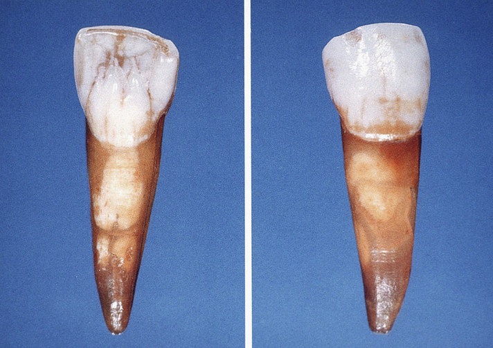 La dent de Néandertalien découverte en 1955 dans la grotte de Saint-Brais II